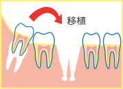 自家歯牙移植の流れイラスト02