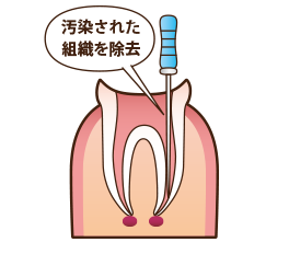 根管治療のイラスト02