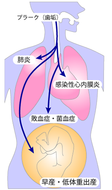 歯周病が関係する主な疾患イラスト