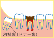 自家歯牙移植の流れイラスト01